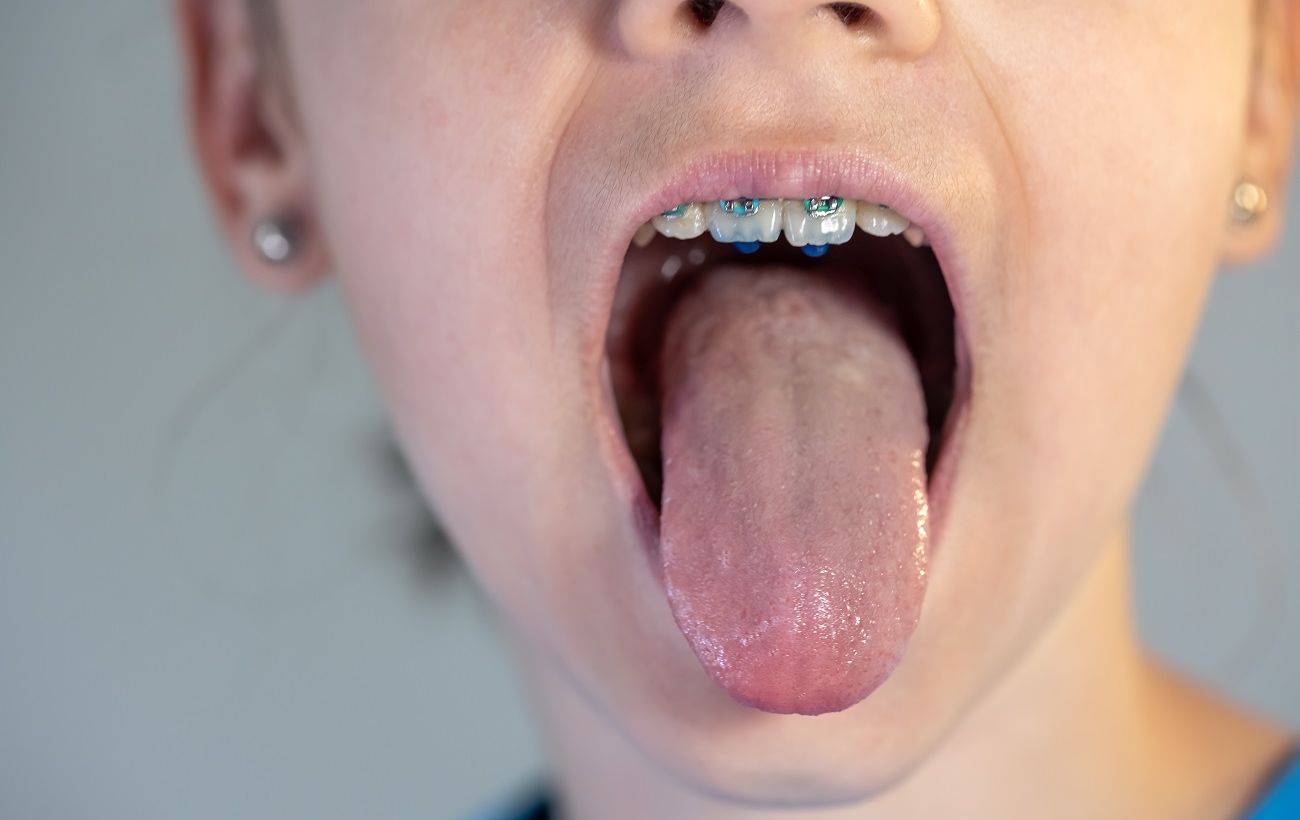 Чому на язику зранку з’являється білий наліт: коли це норма, а коли варто насторожитися