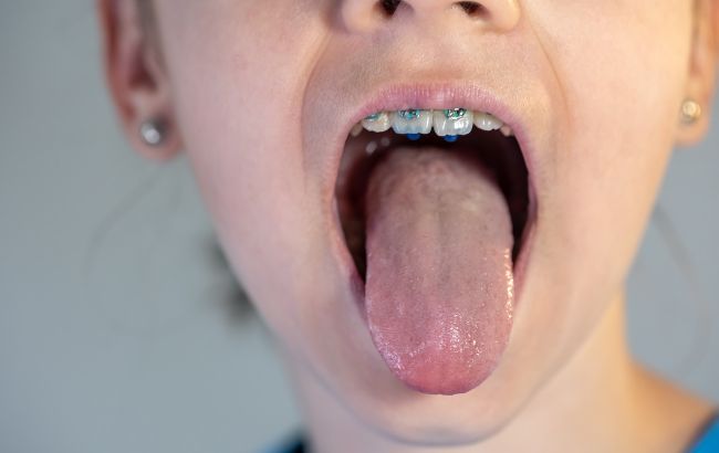 Чому на язику зранку з’являється білий наліт: коли це норма, а коли варто насторожитися