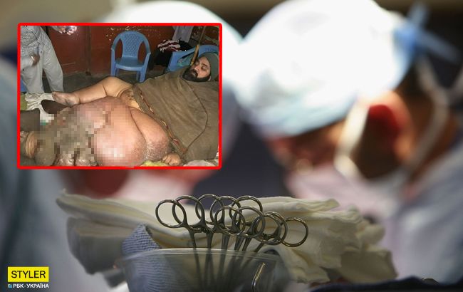 Мужчина умоляет отрезать ему ногу весом 150 килограммов (фото 18 +)