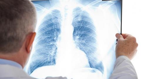 "Висока захворюваність": Супрун розповіла, скільки українців хворіють на рак легенів