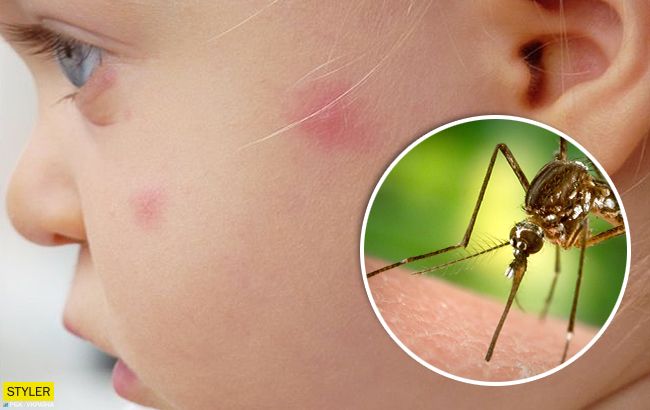Ребенка укусило насекомое: Комаровский дал родителям важные советы о первой помощи