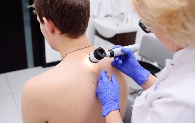 Когда бить тревогу. Врач рассказал, могут ли родинки переродиться в меланому
