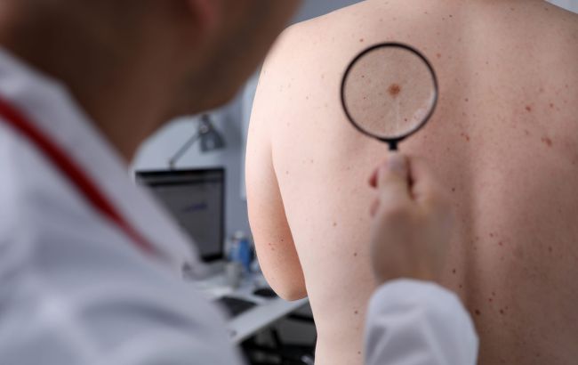 Небезпечна меланома: лікарі назвали перші ознаки раку шкіри