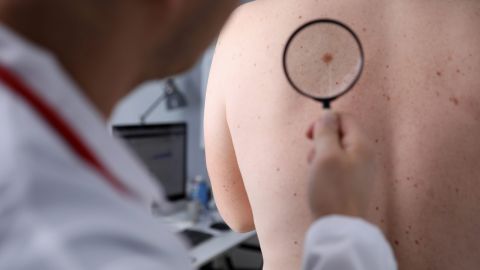 Лікарі назвали ранні ознаки раку шкіри: не пропустіть!