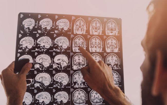 Как распознать симптомы рака мозга и кто в группе риска: украинские врачи дали ответ