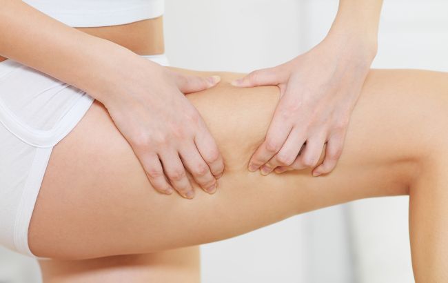 Чем опасен целлюлит и как его убрать? Ответ врача