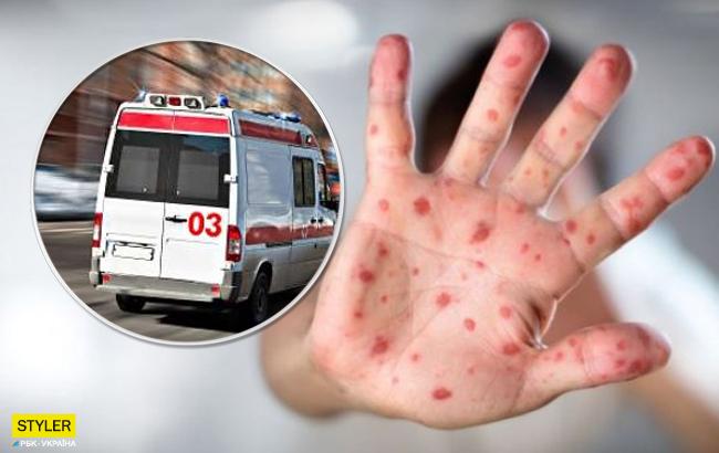 В Одессе от кори умер ребенок: подробности инцидента