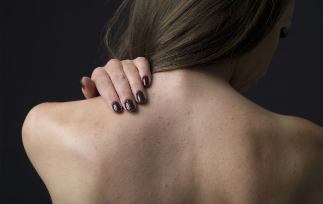 З'являються прищі на спині? Ці способи допоможуть позбутися їх назавжди