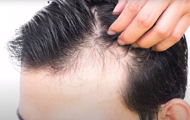 Зупинить випадання волосся і прискорить зростання: вчені назвали аптечний засіб за 50 грн