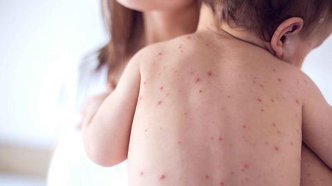 Кір у Києві: кількість хворих збільшилась до 87