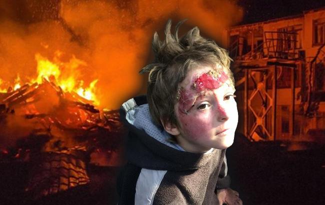 У мережі розповіли шокуючу історію хлопчика, постраждалого під час пожежі
