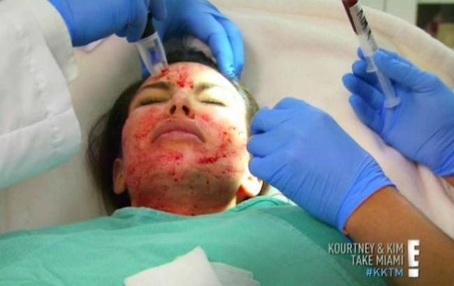 Кім Кардашьян зізналася, яку косметологічну процедуру ніколи б не повторила