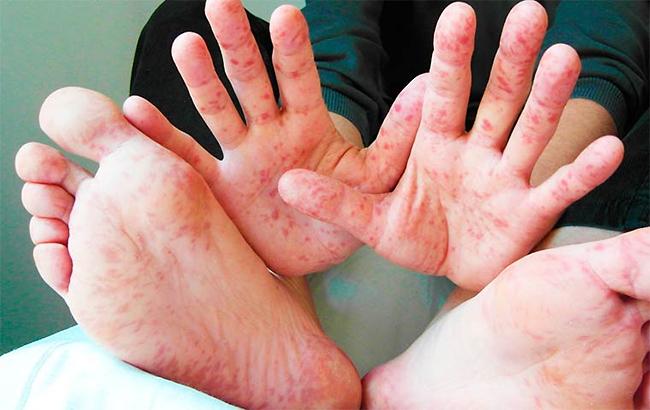 Вспышка кори в Украине: во Львовской области заболели 18 человек