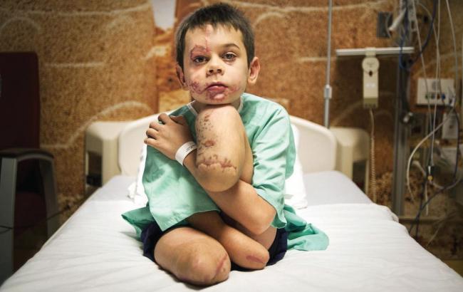 Скалічений на Донбасі хлопчик віджався заради українських бійців
