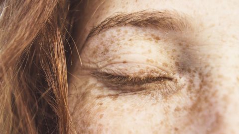 Лікар назвав найголовнішу небезпеку веснянок