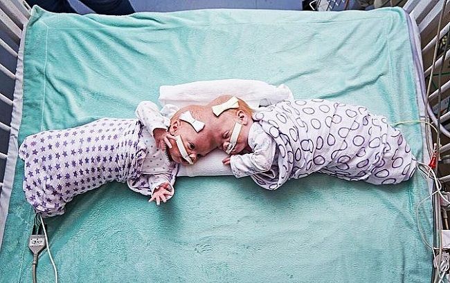 Две головы и одно тело: в Йемене родились редкие сиамские близнецы (фото)