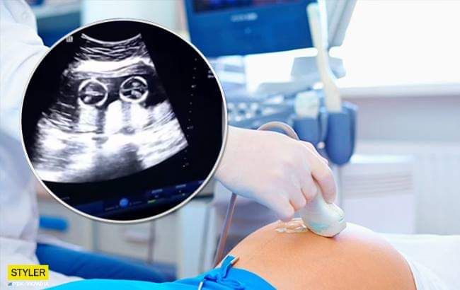 Бійка близнюків в утробі матері: в мережі показали захоплююче відео