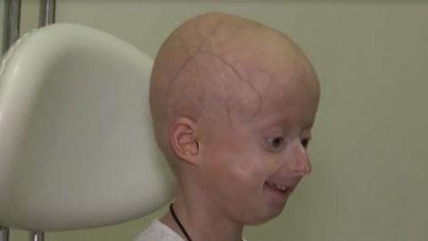 В Украине провели уникальную операцию 7-летней девочке, организм которой постарел на 60 лет