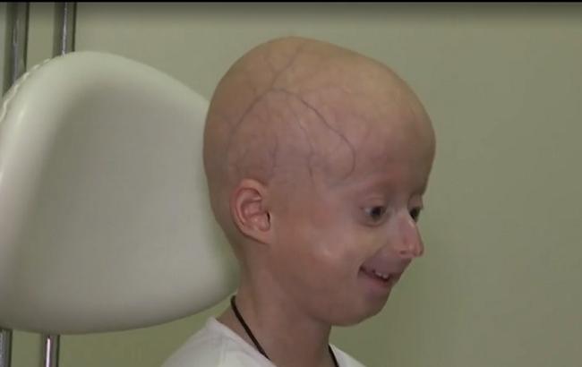 В Украине провели уникальную операцию 7-летней девочке, организм которой постарел на 60 лет