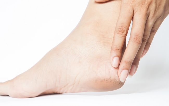 Більше ніяких тріщин: як вилікувати п&rsquo;яти вдома та не проґавити небезпечний симптом