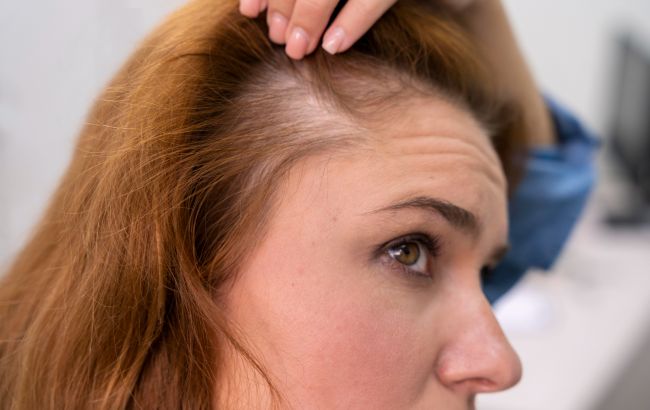 Норма или патология: стоит ли паниковать, когда выпадают волосы после родов