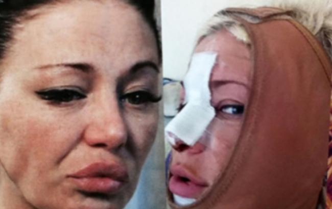 Російська співачка отримає 2 млн рублів від хірурга, який зробив їй невдалу пластику